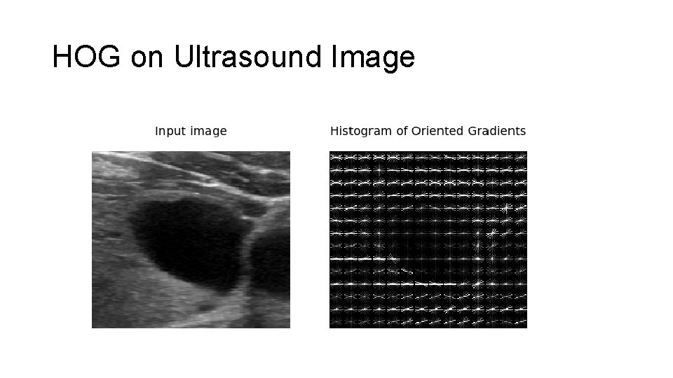HOG on Ultrasound Image HOG on Ultrasound Image