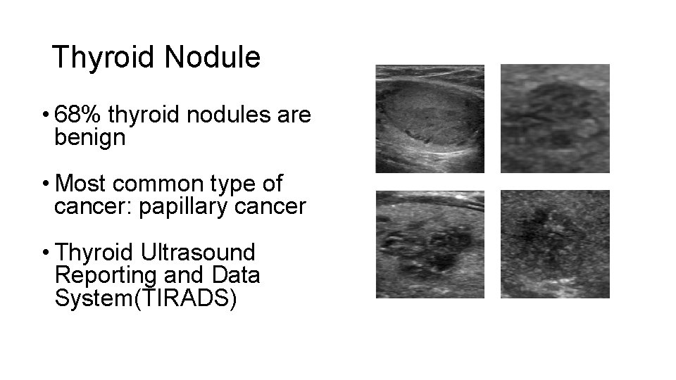 Thyroid Nodule • 68% thyroid nodules are benign • Most common type of cancer: Thyroid Nodule • 68% thyroid nodules are benign • Most common type of cancer: