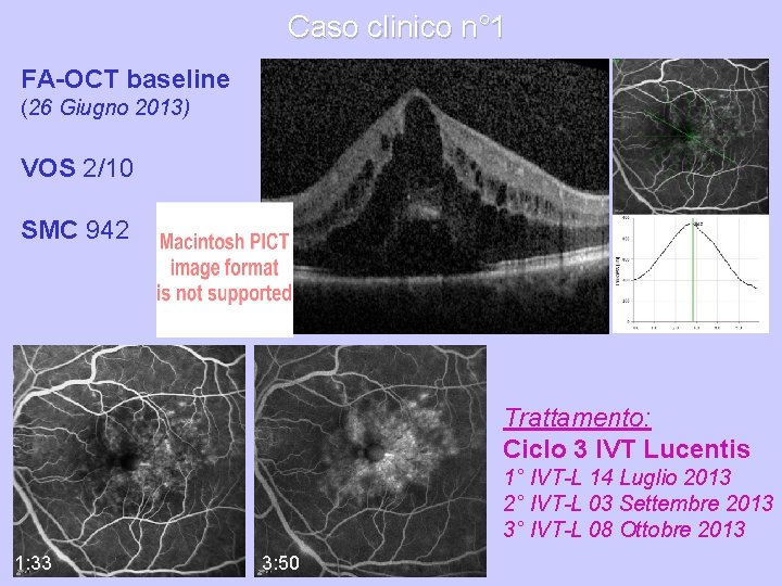 Caso clinico n° 1 FA-OCT baseline (26 Giugno 2013) VOS 2/10 SMC 942 Trattamento: