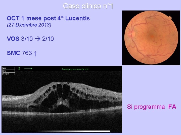 Caso clinico n° 1 OCT 1 mese post 4° Lucentis (27 Dicembre 2013) VOS