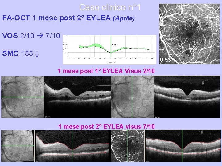 Caso clinico n° 1 FA-OCT 1 mese post 2° EYLEA (Aprile) VOS 2/10 7/10