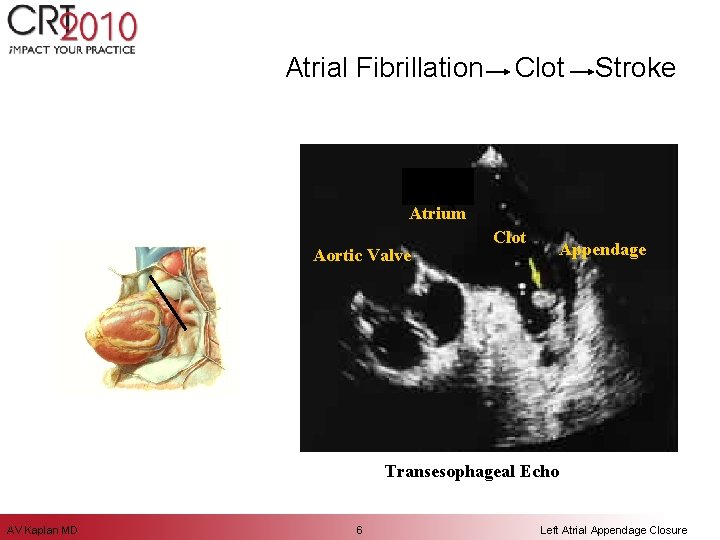 Atrial Fibrillation Clot Stroke LA Atrium Aortic Valve Clot Appendage Transesophageal Echo AV Kaplan