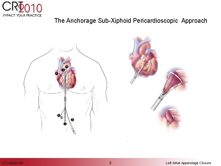 The Anchorage Sub-Xiphoid Pericardioscopic Approach AV Kaplan MD 8 Left Atrial Appendage Closure 