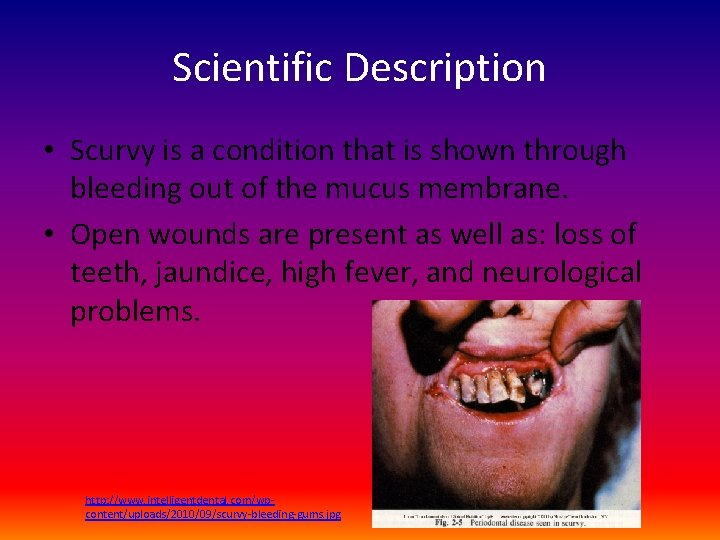 Scientific Description • Scurvy is a condition that is shown through bleeding out of