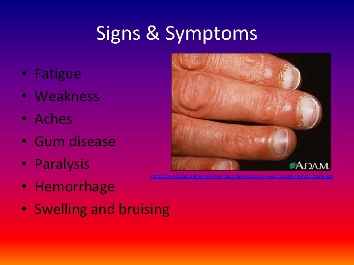 Signs & Symptoms • • Fatigue Weakness Aches Gum disease Paralysis Hemorrhage Swelling and