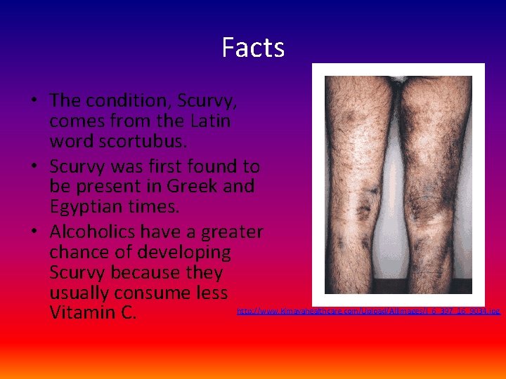 Facts • The condition, Scurvy, comes from the Latin word scortubus. • Scurvy was