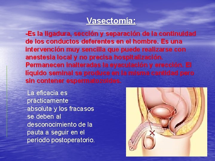 Vasectomía: -Es la ligadura, sección y separación de la continuidad de los conductos deferentes