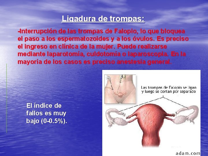 Ligadura de trompas: -Interrupción de las trompas de Falopio, lo que bloquea el paso