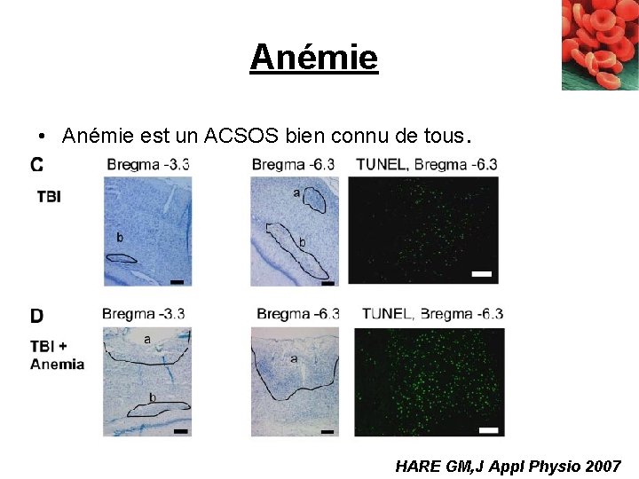 Anémie • Anémie est un ACSOS bien connu de tous. HARE GM, J Appl