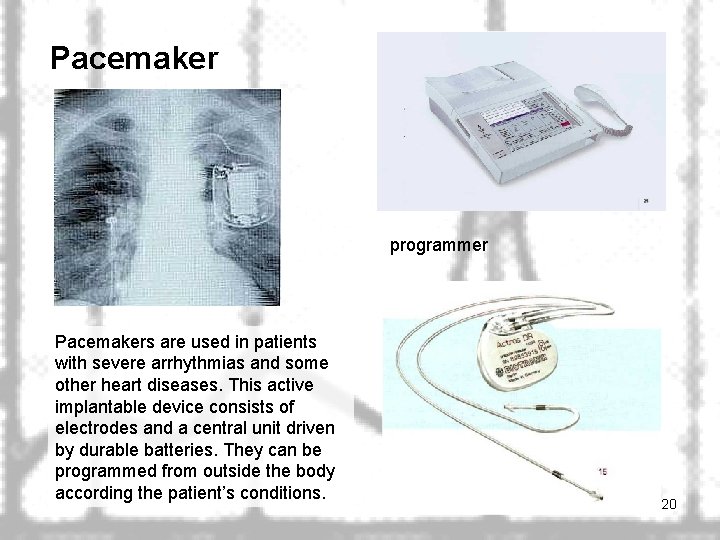 Pacemaker programmer Pacemakers are used in patients with severe arrhythmias and some other heart