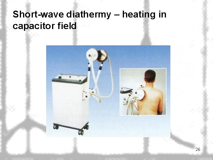 Short-wave diathermy – heating in capacitor field 26 