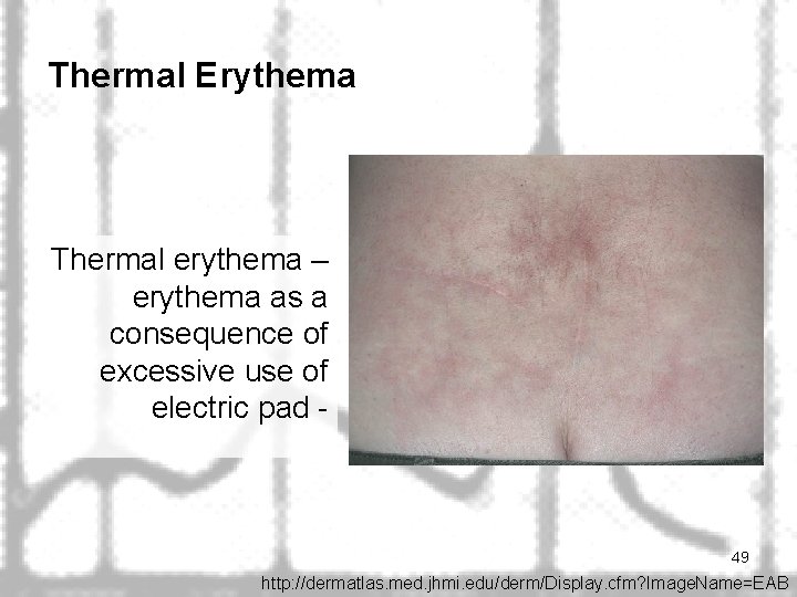 Thermal Erythema Thermal erythema – erythema as a consequence of excessive use of electric