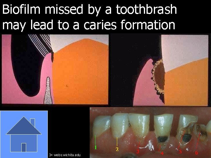 Biofilm missed by a toothbrash may lead to a caries formation 3× webs. wichita.