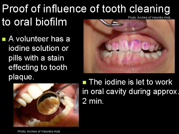 Proof of influence of tooth cleaning to oral biofilm Photo: Archive of Veronika Holá