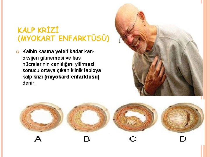 KALP KRİZİ (MYOKART ENFARKTÜSÜ) Kalbin kasına yeteri kadar kanoksijen gitmemesi ve kas hücrelerinin canlılığını