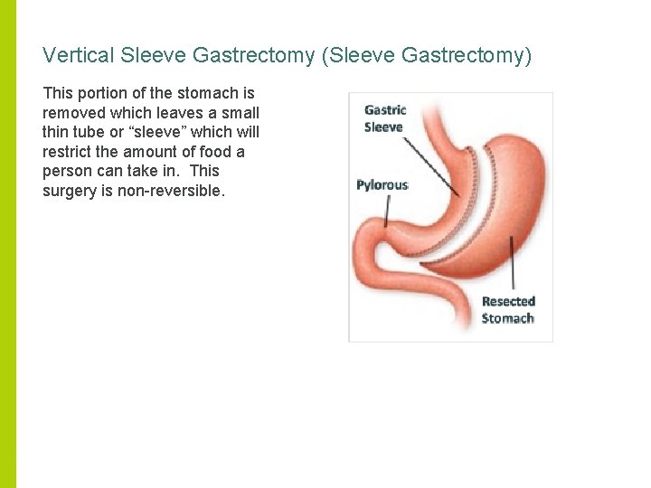 Vertical Sleeve Gastrectomy (Sleeve Gastrectomy) This portion of the stomach is removed which leaves