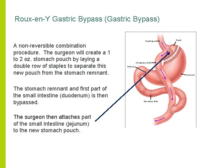 Roux-en-Y Gastric Bypass (Gastric Bypass) A non-reversible combination procedure. The surgeon will create a