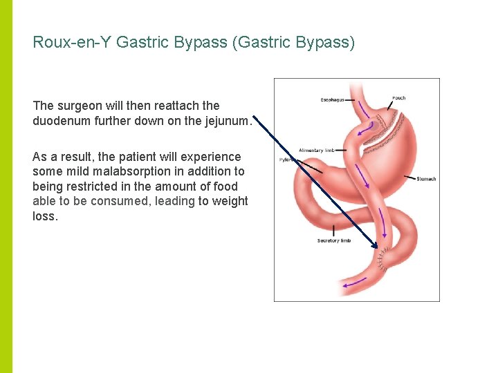 Roux-en-Y Gastric Bypass (Gastric Bypass) The surgeon will then reattach the duodenum further down