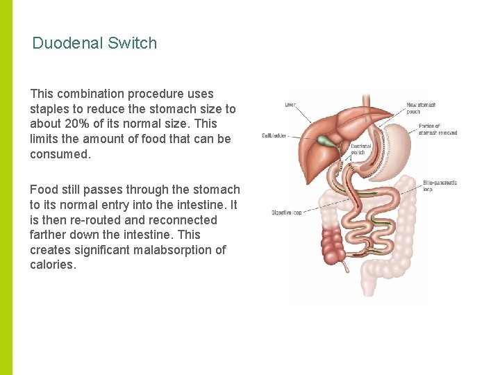 Duodenal Switch This combination procedure uses staples to reduce the stomach size to about