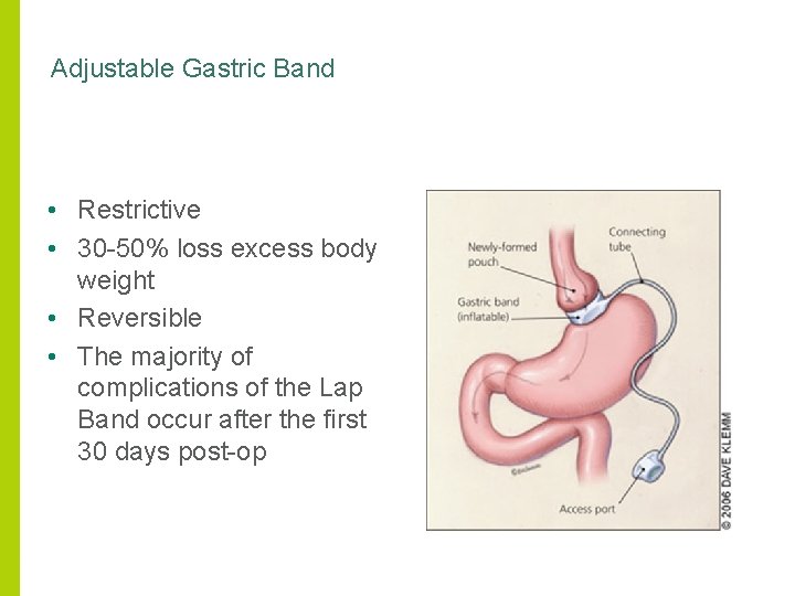 Adjustable Gastric Band • Restrictive • 30 -50% loss excess body weight • Reversible