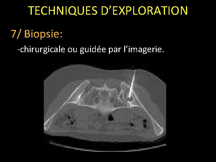 TECHNIQUES D’EXPLORATION 7/ Biopsie: -chirurgicale ou guidée par l’imagerie. 