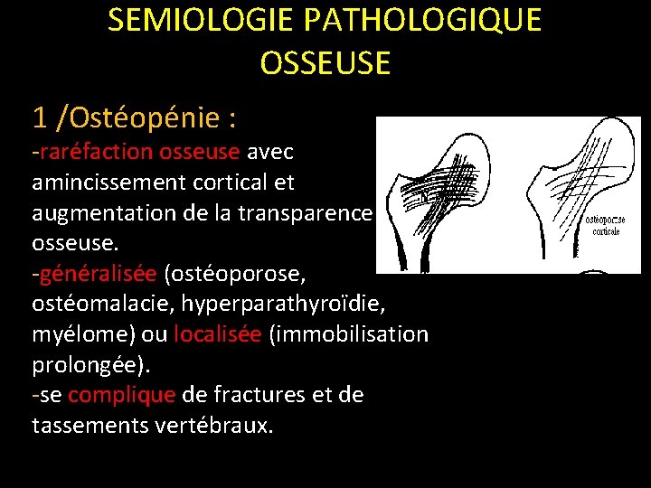 SEMIOLOGIE PATHOLOGIQUE OSSEUSE 1 /Ostéopénie : -raréfaction osseuse avec amincissement cortical et augmentation de