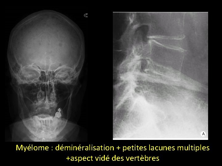 Myélome : déminéralisation + petites lacunes multiples +aspect vidé des vertèbres 