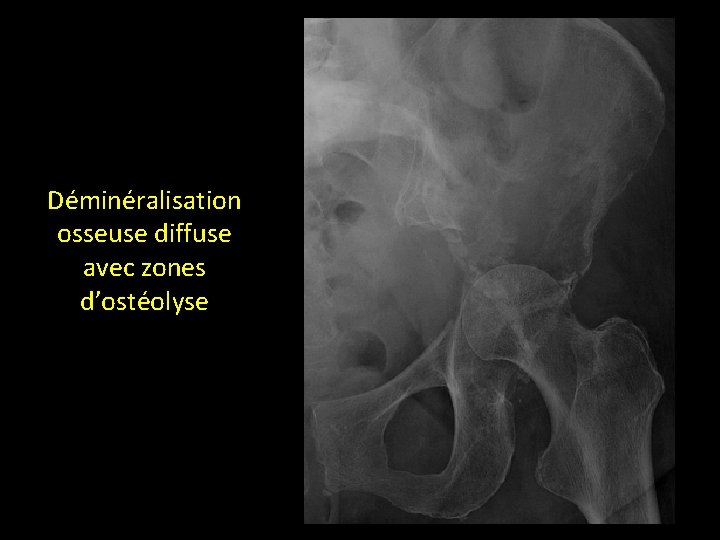 Déminéralisation osseuse diffuse avec zones d’ostéolyse 