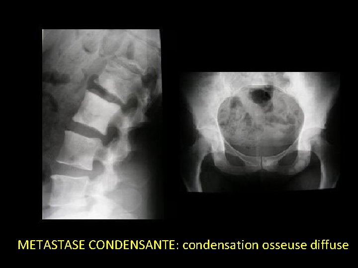 METASTASE CONDENSANTE: condensation osseuse diffuse 