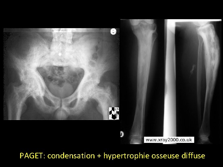 PAGET: condensation + hypertrophie osseuse diffuse 