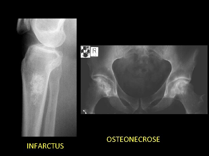 INFARCTUS OSTEONECROSE 