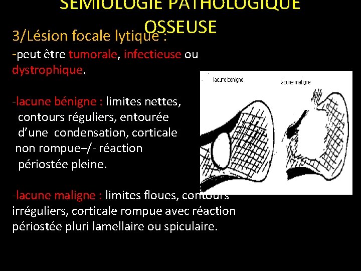 SEMIOLOGIE PATHOLOGIQUE OSSEUSE 3/Lésion focale lytique : -peut être tumorale, infectieuse ou dystrophique. -lacune