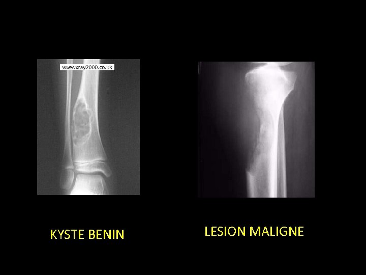 KYSTE BENIN LESION MALIGNE 