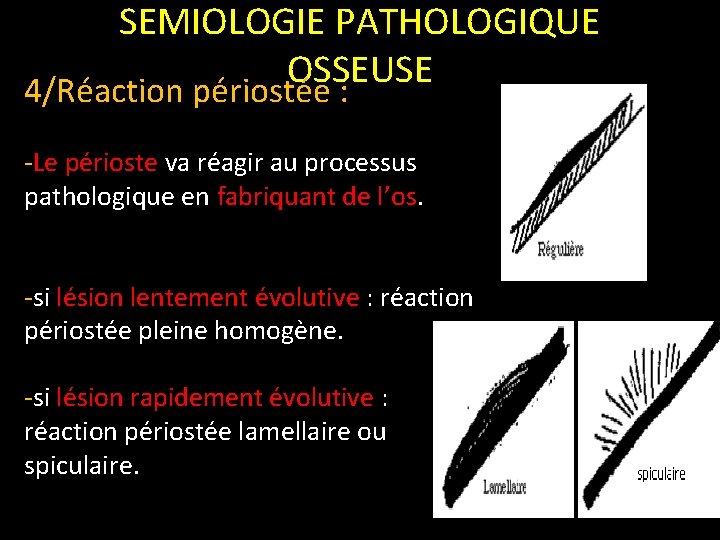 SEMIOLOGIE PATHOLOGIQUE OSSEUSE 4/Réaction périostée : -Le périoste va réagir au processus pathologique en