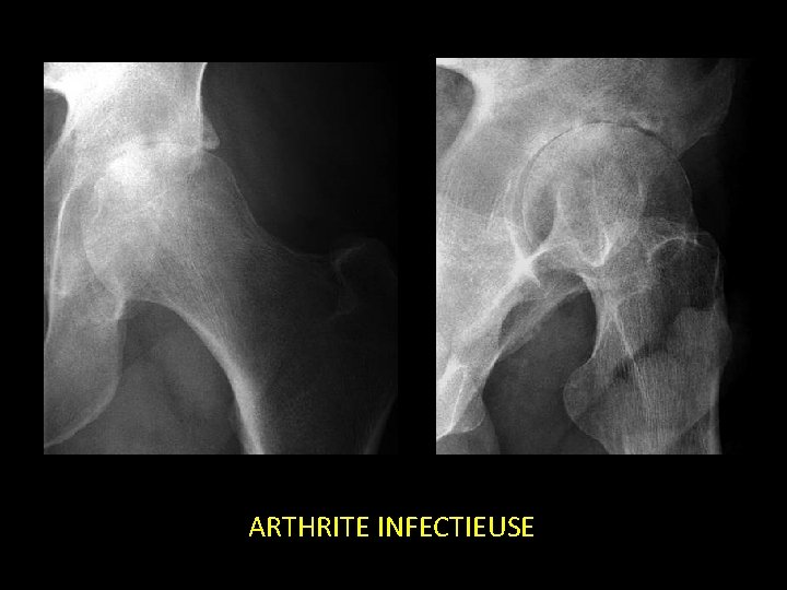 ARTHRITE INFECTIEUSE 