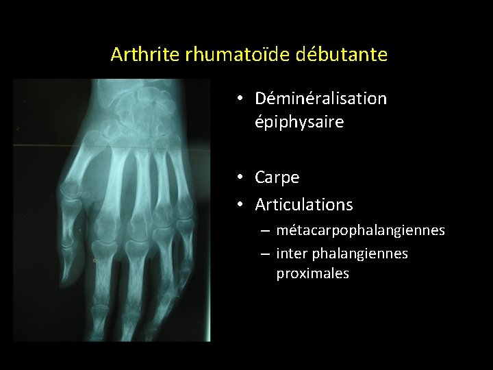 GRANDS SYNDROMES RADIOLOGIQUES Arthrite rhumatoïde débutante • Déminéralisation épiphysaire • Carpe • Articulations –