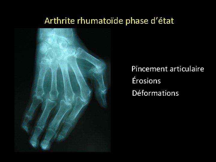 GRANDS SYNDROMES RADIOLOGIQUES Arthrite rhumatoïde phase d’état • Pincement articulaire Érosions Déformations 