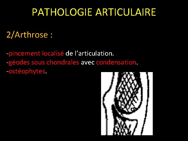 PATHOLOGIE ARTICULAIRE 2/Arthrose : -pincement localisé de l’articulation. -géodes sous chondrales avec condensation. -ostéophytes.
