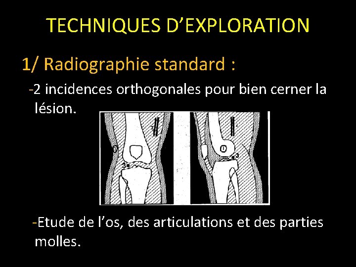 TECHNIQUES D’EXPLORATION 1/ Radiographie standard : -2 incidences orthogonales pour bien cerner la lésion.