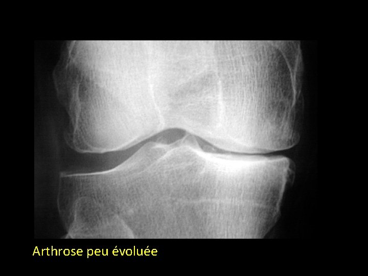 Arthrose peu évoluée 
