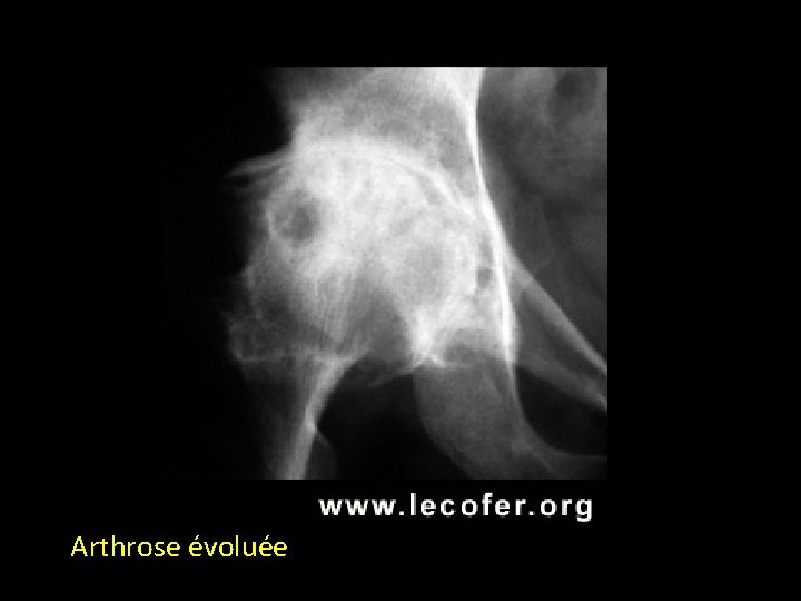 Arthrose évoluée 