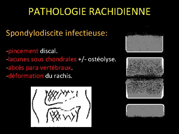 PATHOLOGIE RACHIDIENNE Spondylodiscite infectieuse: -pincement discal. -lacunes sous chondrales +/- ostéolyse. -abcès para vertébraux.