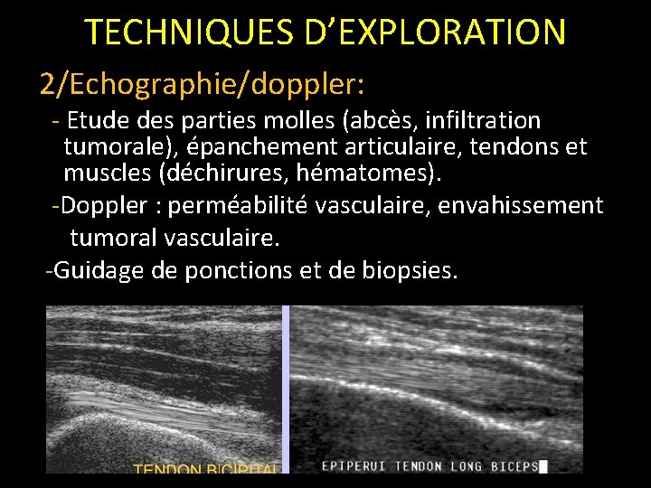 TECHNIQUES D’EXPLORATION 2/Echographie/doppler: - Etude des parties molles (abcès, infiltration tumorale), épanchement articulaire, tendons