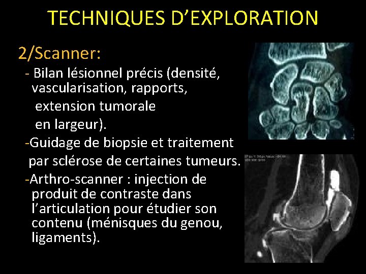 TECHNIQUES D’EXPLORATION 2/Scanner: - Bilan lésionnel précis (densité, vascularisation, rapports, extension tumorale en largeur).