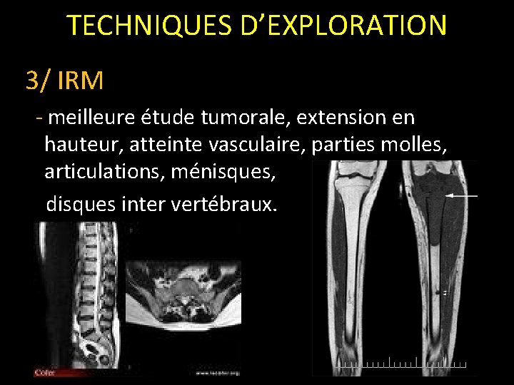 TECHNIQUES D’EXPLORATION 3/ IRM - meilleure étude tumorale, extension en hauteur, atteinte vasculaire, parties