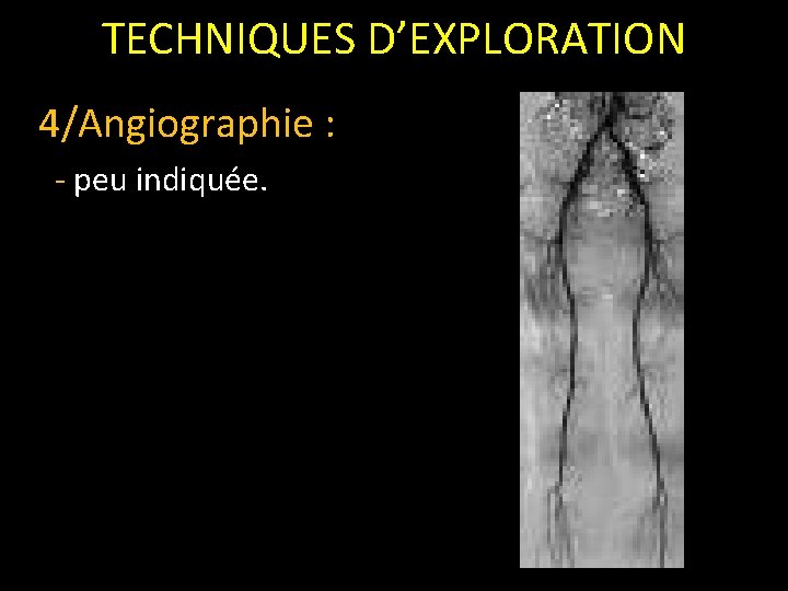 TECHNIQUES D’EXPLORATION 4/Angiographie : - peu indiquée. 
