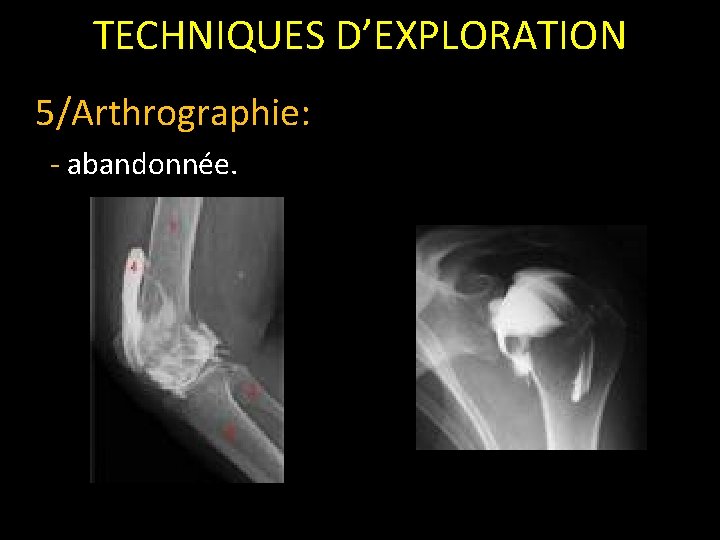 TECHNIQUES D’EXPLORATION 5/Arthrographie: - abandonnée. 