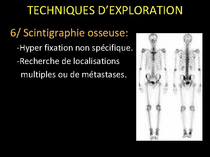 TECHNIQUES D’EXPLORATION 6/ Scintigraphie osseuse: -Hyper fixation non spécifique. -Recherche de localisations multiples ou