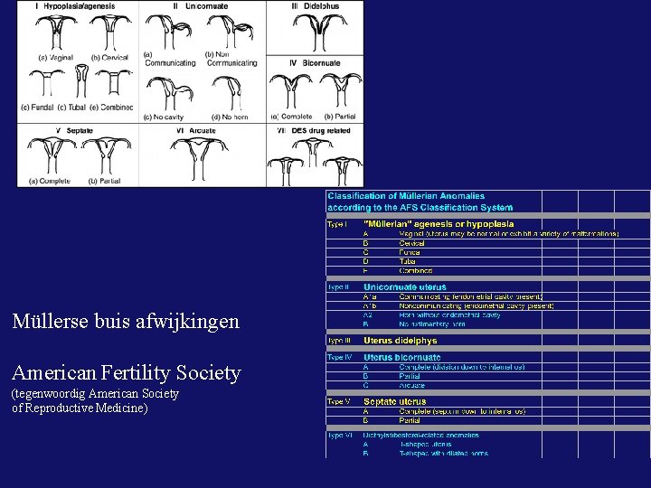 Müllerse buis afwijkingen American Fertility Society (tegenwoordig American Society of Reproductive Medicine) 