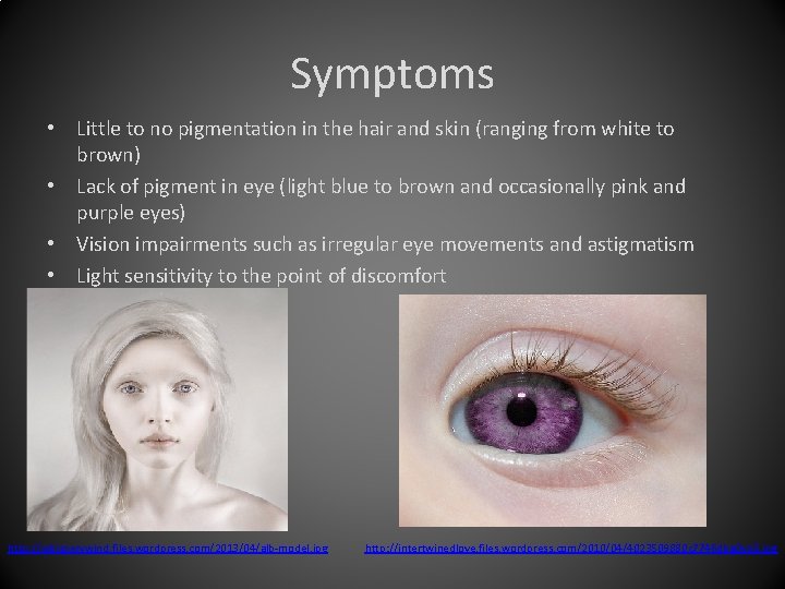 Symptoms • Little to no pigmentation in the hair and skin (ranging from white